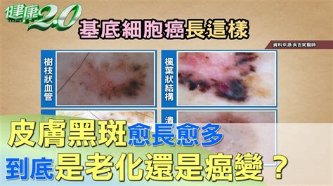 屁股長黑斑|皮膚斑點愈長愈多，要不要緊？